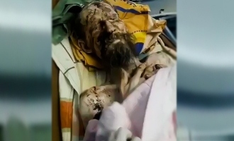 Man rescued from bear den after a month resembles a mummy