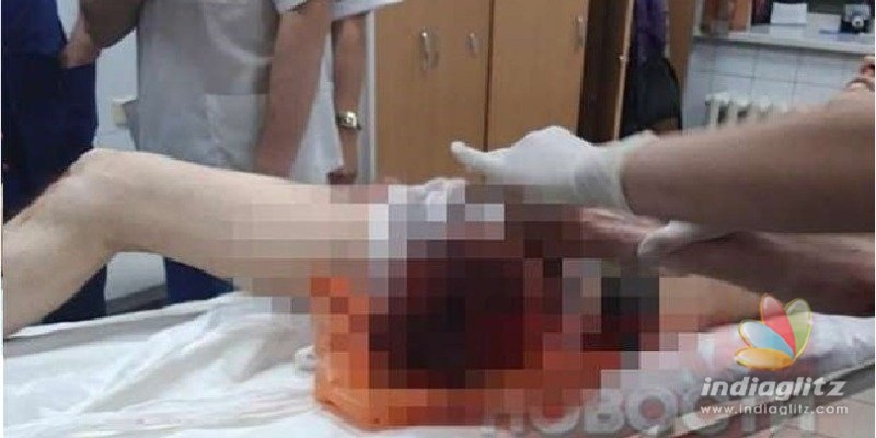 High on drug: Young man cuts off his own leg!