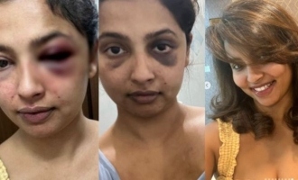 Actress Anicka alleges brutal attack by ex-boyfriend, shares shocking pics