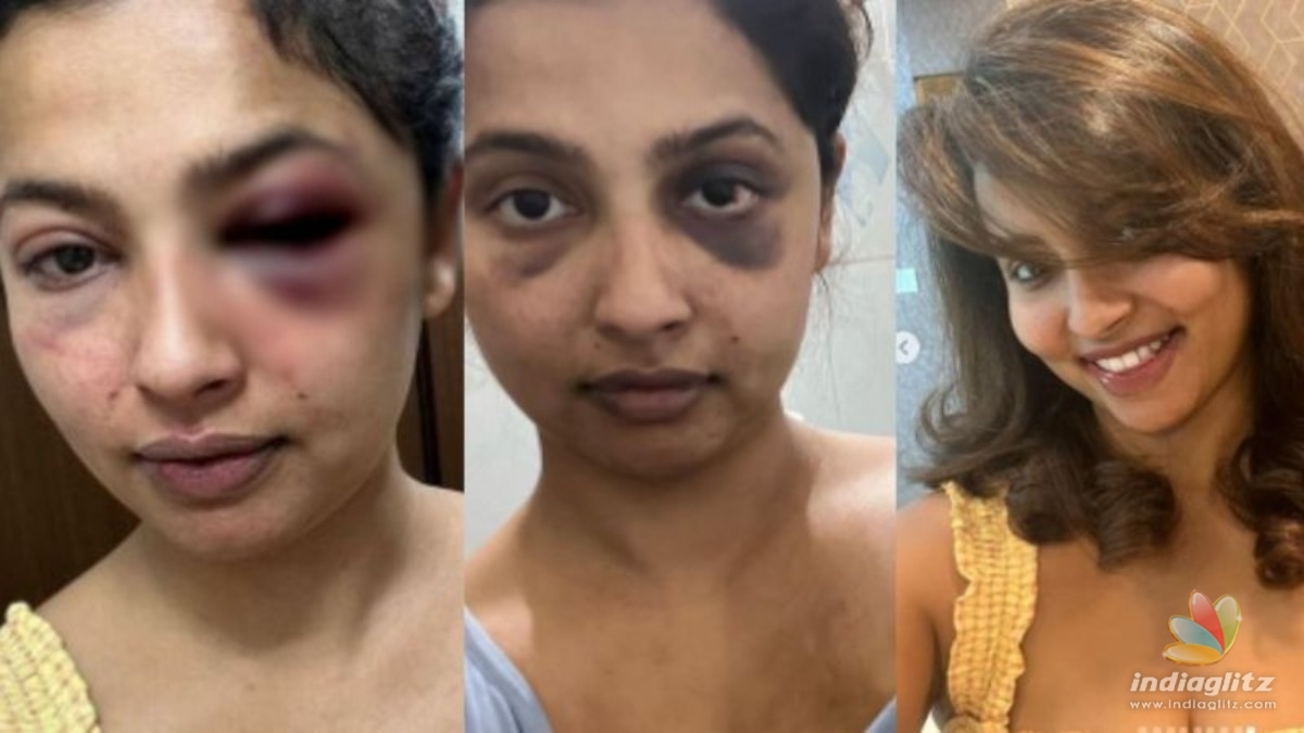 Actress Anicka severely beaten up by ex-boyfriend, shares shocking pics