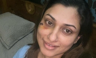 Actress Malavika hurt in an accident