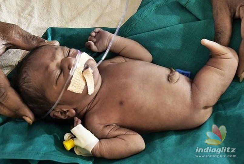 Baby born with tail, fused legs in India